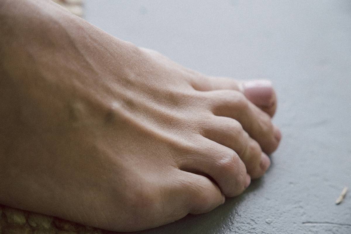comparison of cracked feet before and after consistent cms routine foot care